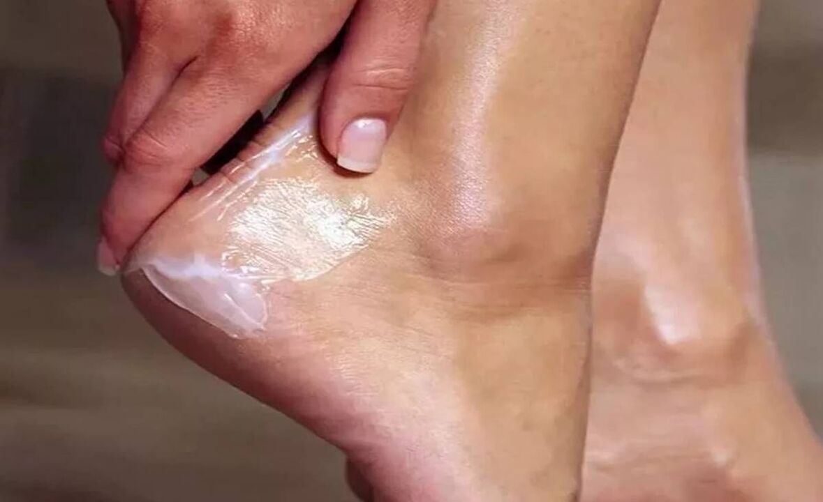Como tratar o cogomelo do pé con crema funxente