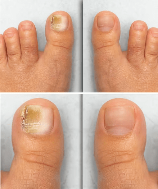 Fungo de pé antes e despois do tratamento con crema de funxes