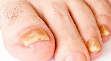 Como tratar o fungo das uñas