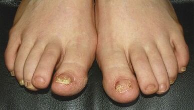 Sinais e síntomas de cogomelos nas uñas