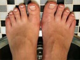 Cogomelo nas uñas e pel das pernas