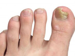 Manchas amarelas nas uñas do sinal do pé do cogomelo