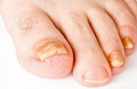 Amarelelamento das uñas dos pés debido á infección por fungos