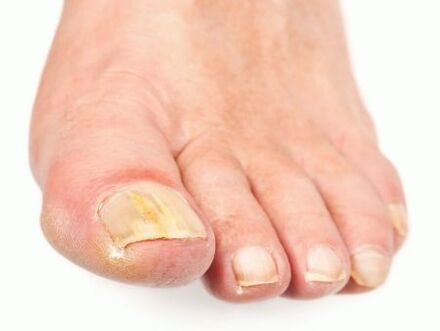 Danos por fungos nas unhas
