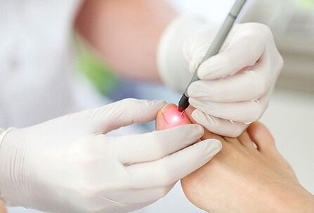 Tratamento con láser para fungos nas unhas dos pés