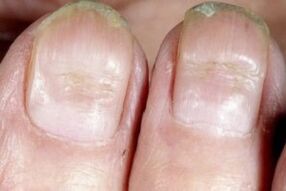 Síntomas de fungo nas unhas