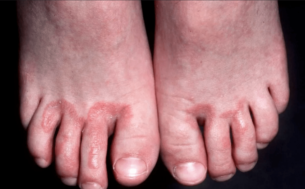 Complicacións dos fungos nas unhas