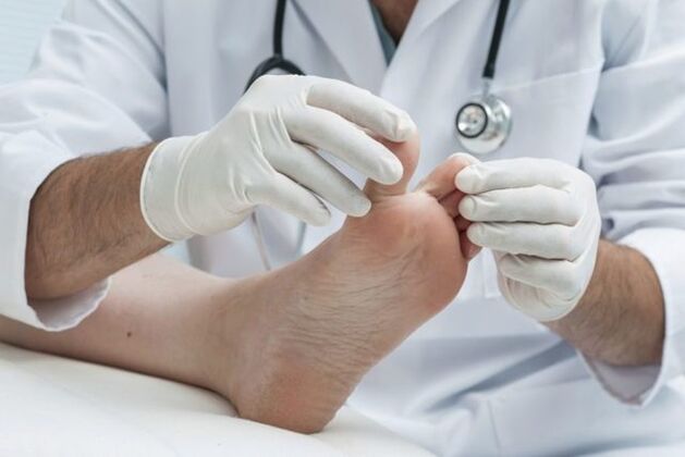 Diagnóstico do pé de atleta por un médico