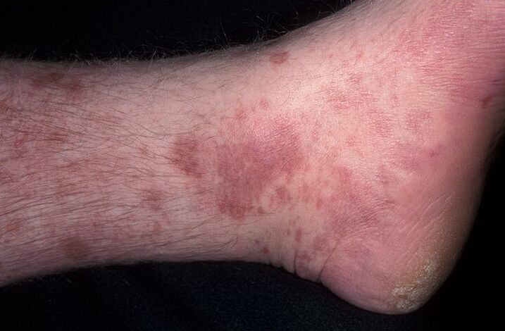 Eczema micótico na perna