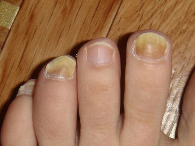 Síntomas de fungo nas unhas dos pés