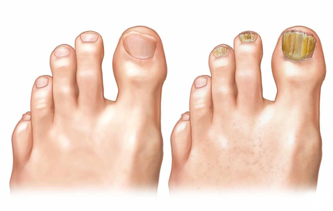 unhas saudables e fungos das unhas dos pés