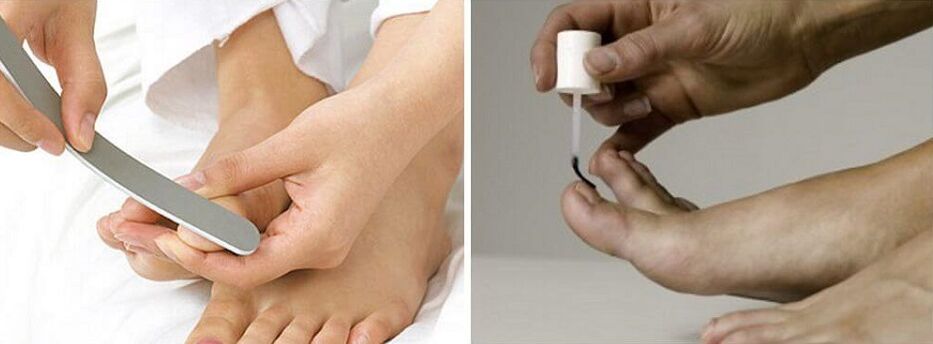 Tratamento de fungos nas unhas con verniz